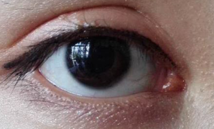 開外眼角什么價格？開外眼角什么時候能好？