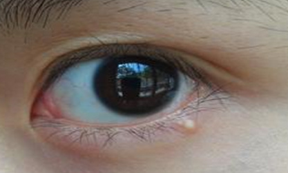 開外眼角手術(shù)會有后遺癥嗎？