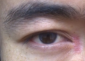 開眼角術(shù)后如何快速消腫？