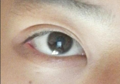 開眼角手術(shù)后會(huì)影響視力嗎？