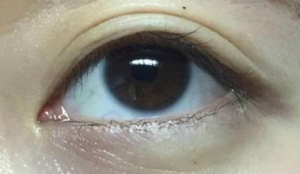 開眼角手術(shù)多長(zhǎng)時(shí)間恢復(fù)？
