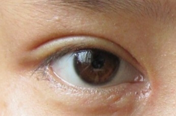 開(kāi)眼角手術(shù)會(huì)不會(huì)留疤？開(kāi)眼角手術(shù)后應(yīng)該注意什么？