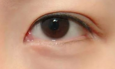 做完開眼角手術(shù)有什么優(yōu)勢(shì)？