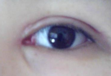 做完雙眼皮開內(nèi)眼角有風(fēng)險(xiǎn)嗎？做完開眼角怎樣護(hù)理？