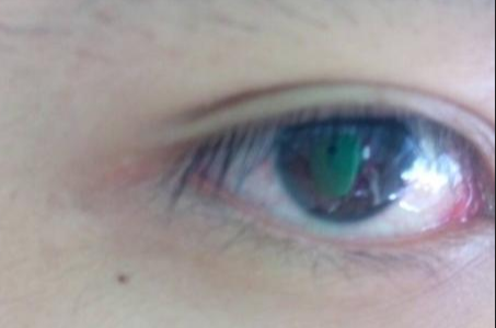 開(kāi)眼角手術(shù)完全恢復(fù)需要多長(zhǎng)時(shí)間？術(shù)后如何避免留疤？