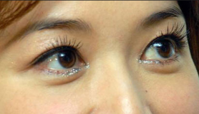 開眼角手術(shù)的優(yōu)點(diǎn)有哪些？