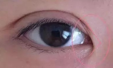 開眼角手術(shù)價格要多少錢？