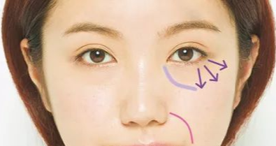 開眼角手術(shù)有沒有副作用？