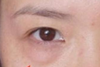 光纖溶脂去眼袋手術有哪些優(yōu)勢？