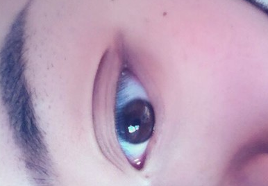 不開刀祛眼袋效果怎么樣？玻尿酸祛眼袋多少錢呢？