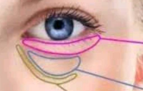 眶隔脂肪釋放去眼袋效果怎么樣呢？優(yōu)點有哪些？