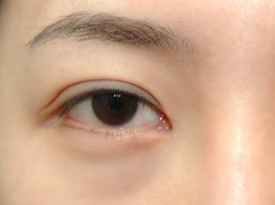 光纖溶脂去眼袋要多久消腫？術(shù)后如何護(hù)理？