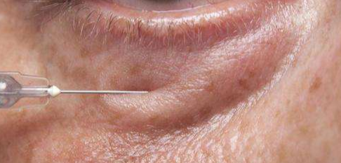 眼袋脂肪釋放的優(yōu)點(diǎn)有哪些？