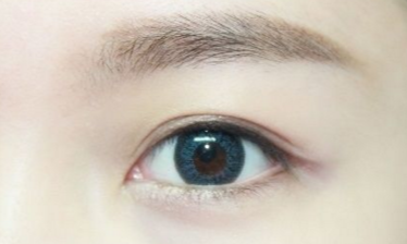 開(kāi)眼角需要注意的事項(xiàng)有哪些？