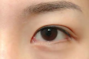 光纖溶脂祛眼袋有效果嗎？