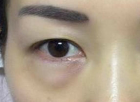 光纖溶脂去眼袋術(shù)后如何護理？