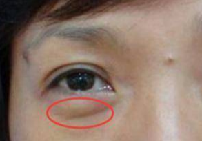 埋線去眼袋能維持多久？