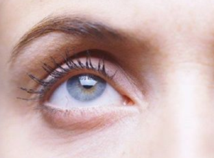 埋線去眼袋什么時候做好？埋線去眼袋有效嗎？