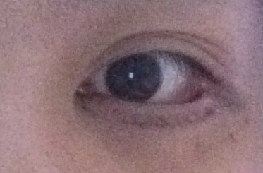 埋線去眼袋有效嗎？