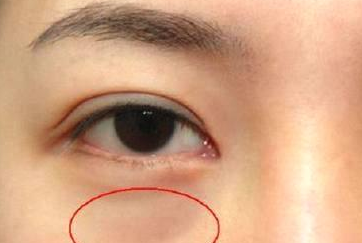 光纖溶脂祛眼袋怎么樣？