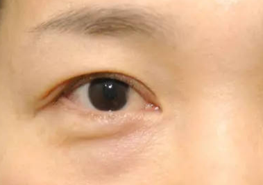 什么是埋線去眼袋？埋線去眼袋能維持多久？