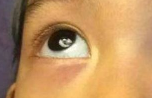 激光祛眼袋需要多少錢？