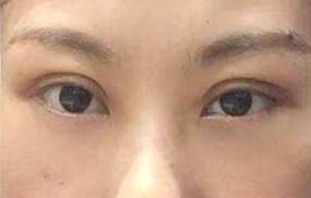 激光去眼袋能維持多長時(shí)間？祛眼袋的手術(shù)效果好嗎？