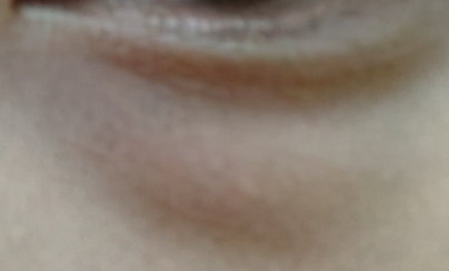 激光去眼袋和內(nèi)切哪個(gè)好？