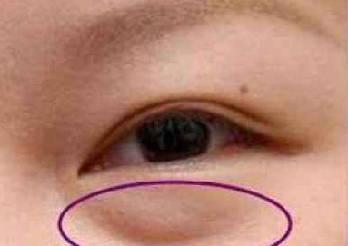 激光去眼袋有什么好處？激光祛眼袋有用嗎？