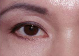 激光可以祛眼袋嗎？