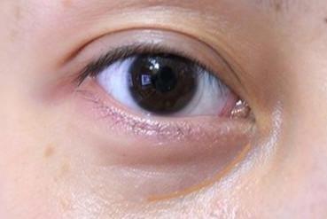 激光祛眼袋是什么原理？激光祛眼袋和內(nèi)切哪個(gè)好？