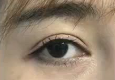 激光祛眼袋痛不痛？激光祛眼袋手術(shù)怎么樣？