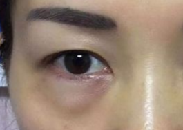 激光可以祛眼袋嗎？