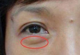 激光祛眼袋要多少錢？