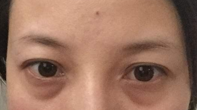 激光祛除眼袋有效嗎？激光祛眼袋有什么利弊？