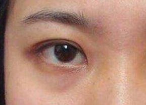 去眼袋是激光好還是內(nèi)切好？激光祛眼袋是什么原理？