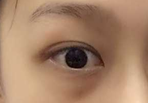 激光祛眼袋要多少錢？