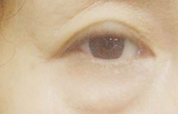 激光祛眼袋能維持多長時間？