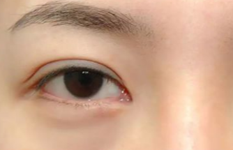 激光去眼袋多久做一次？