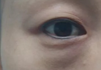 激光去眼袋可以管多久？