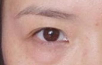 激光去除眼袋后遺癥有哪些？