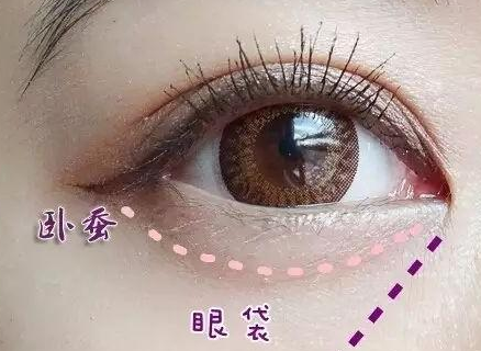 激光消除眼袋怎么樣？激光溶脂去眼袋多少錢？