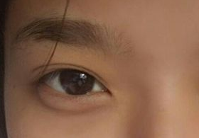 激光去眼袋后需多久能恢復(fù)？激光去眼袋快速有效嗎？