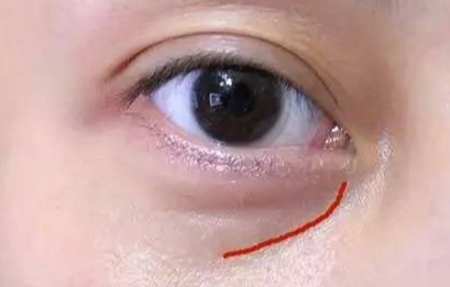 激光去眼袋手術費用是多少？