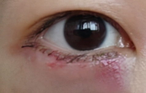 激光去眼袋會不會留疤？