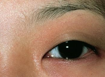 激光祛眼袋可靠嗎？激光去眼袋會(huì)不會(huì)留疤？