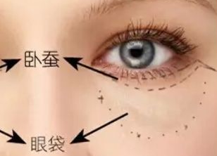 激光去眼袋多久才能恢復？激光去眼袋有什么副作用嗎？