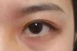 激光祛眼袋效果真的好嗎？激光去眼袋會有風險嗎？