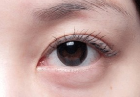 激光去眼袋會(huì)不會(huì)很疼？激光去眼袋什么人適合？