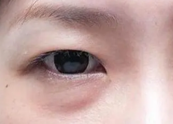 激光去眼袋要多長時間？做激光去眼袋手術(shù)要多久？